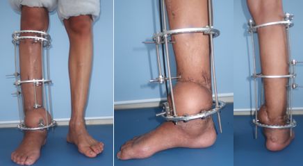 下肢外伤严重只能截肢？保肢新技术出炉！