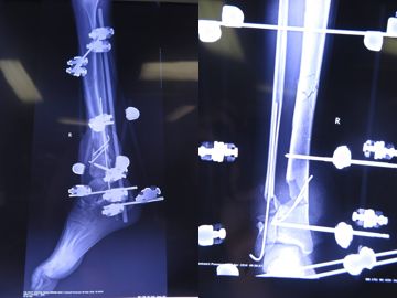 下肢外伤严重只能截肢？保肢新技术出炉！