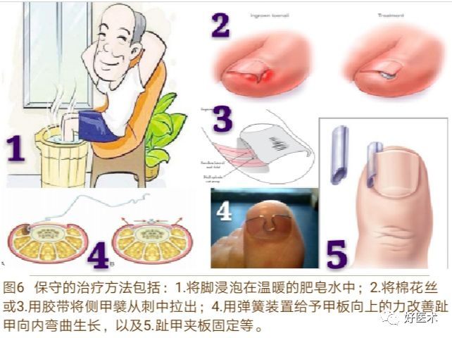 详解治疗嵌甲的7种手术方法，你都掌握了吗？