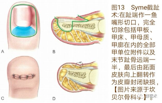 详解治疗嵌甲的7种手术方法，你都掌握了吗？