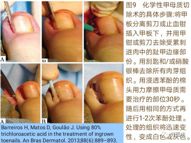 详解治疗嵌甲的7种手术方法，你都掌握了吗？