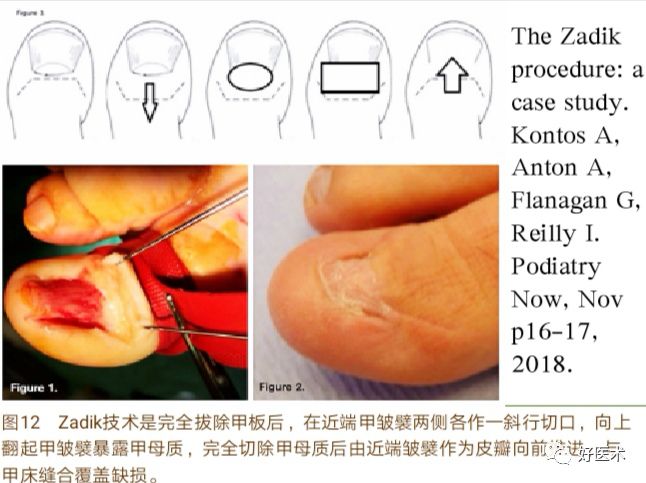 详解治疗嵌甲的7种手术方法，你都掌握了吗？