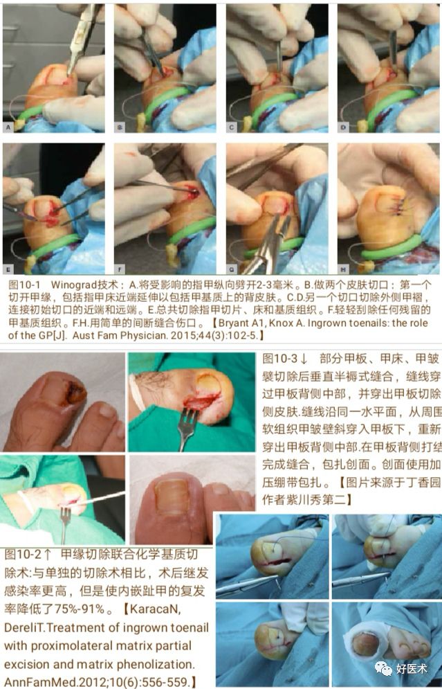 详解治疗嵌甲的7种手术方法，你都掌握了吗？