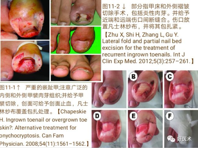 详解治疗嵌甲的7种手术方法，你都掌握了吗？