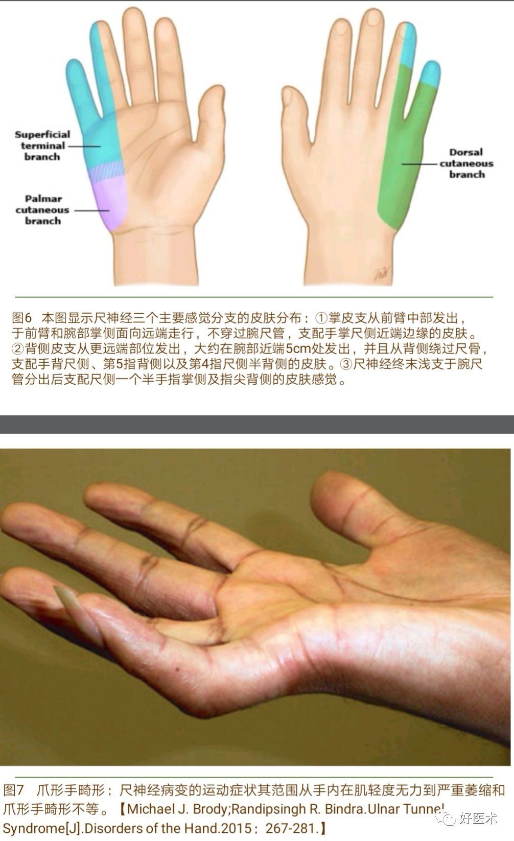 腕尺管综合征的诊治要点，看完这篇就够了！