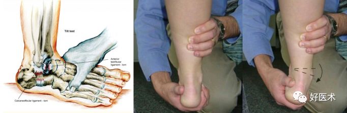 急性踝关节扭伤的诊治要点，看完这篇就够了！
