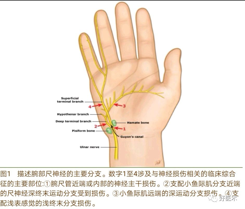 腕尺管综合征的诊治要点，看完这篇就够了！