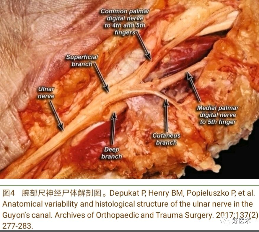 腕尺管综合征的诊治要点，看完这篇就够了！