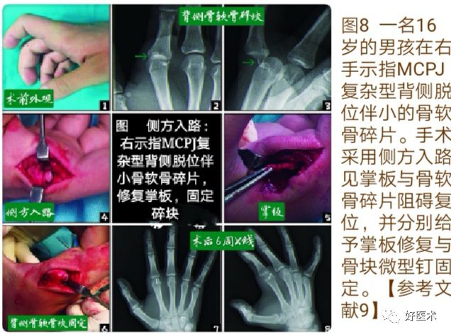 掌指关节脱位的诊治要点，看完这篇就够了！