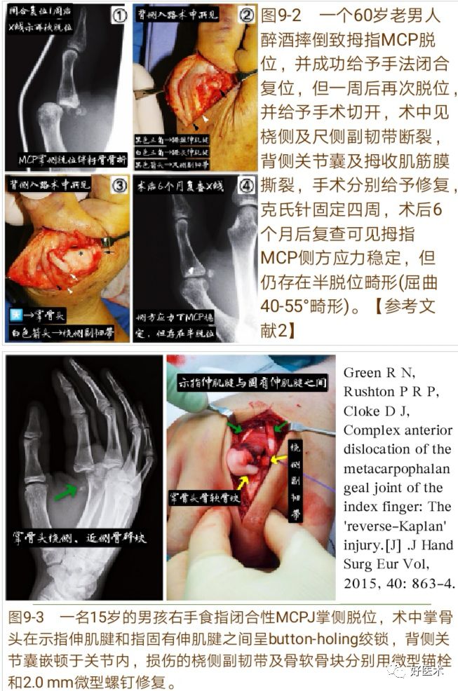 掌指关节脱位的诊治要点，看完这篇就够了！