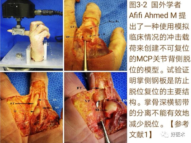 掌指关节脱位的诊治要点，看完这篇就够了！