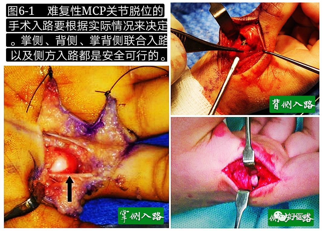 掌指关节脱位的诊治要点，看完这篇就够了！