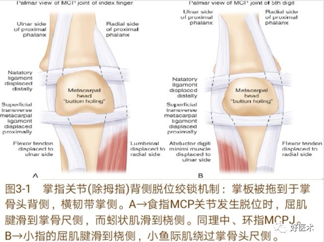 掌指关节脱位的诊治要点，看完这篇就够了！