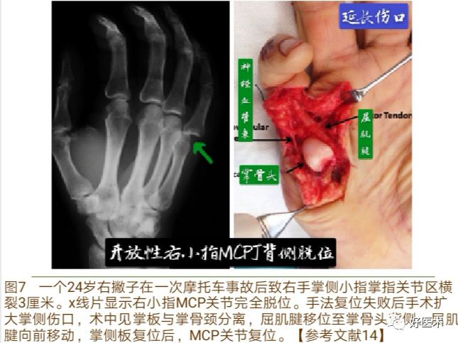 掌指关节脱位的诊治要点，看完这篇就够了！