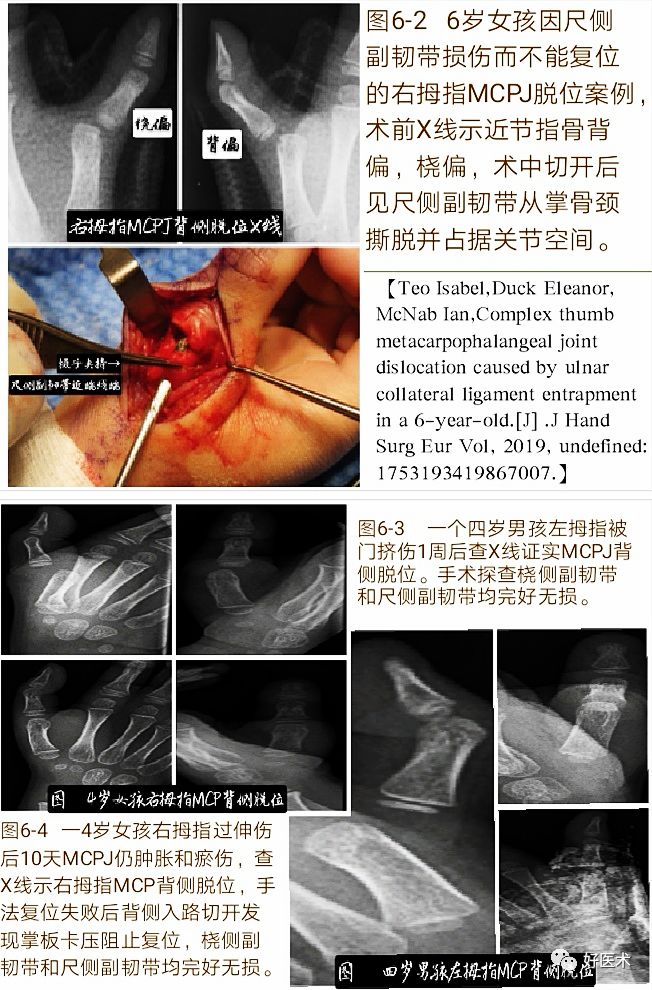 掌指关节脱位的诊治要点，看完这篇就够了！