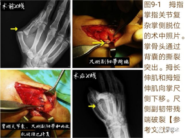 掌指关节脱位的诊治要点，看完这篇就够了！