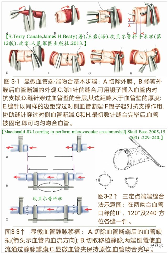 显微血管吻合技术要点详解，值得一看！