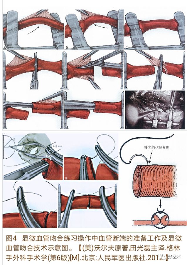 显微血管吻合技术要点详解，值得一看！
