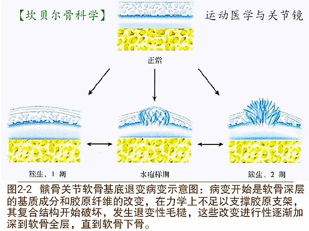 引起青壮年膝前痛的髌骨软骨软化症，你了解吗？