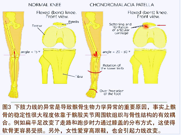 引起青壮年膝前痛的髌骨软骨软化症，你了解吗？