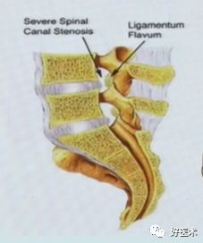 深度讲解！腰椎管狭窄症的解剖及对临床治疗的意义