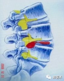 深度讲解！腰椎管狭窄症的解剖及对临床治疗的意义