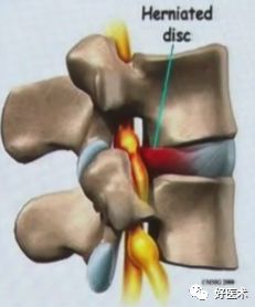 深度讲解！腰椎管狭窄症的解剖及对临床治疗的意义