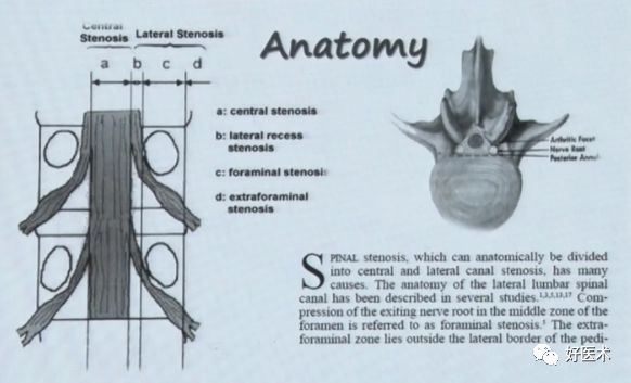 深度讲解！腰椎管狭窄症的解剖及对临床治疗的意义