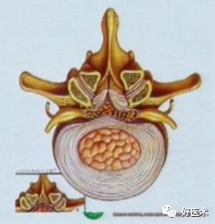 深度讲解！腰椎管狭窄症的解剖及对临床治疗的意义