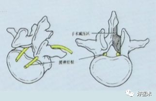 深度讲解！腰椎管狭窄症的解剖及对临床治疗的意义