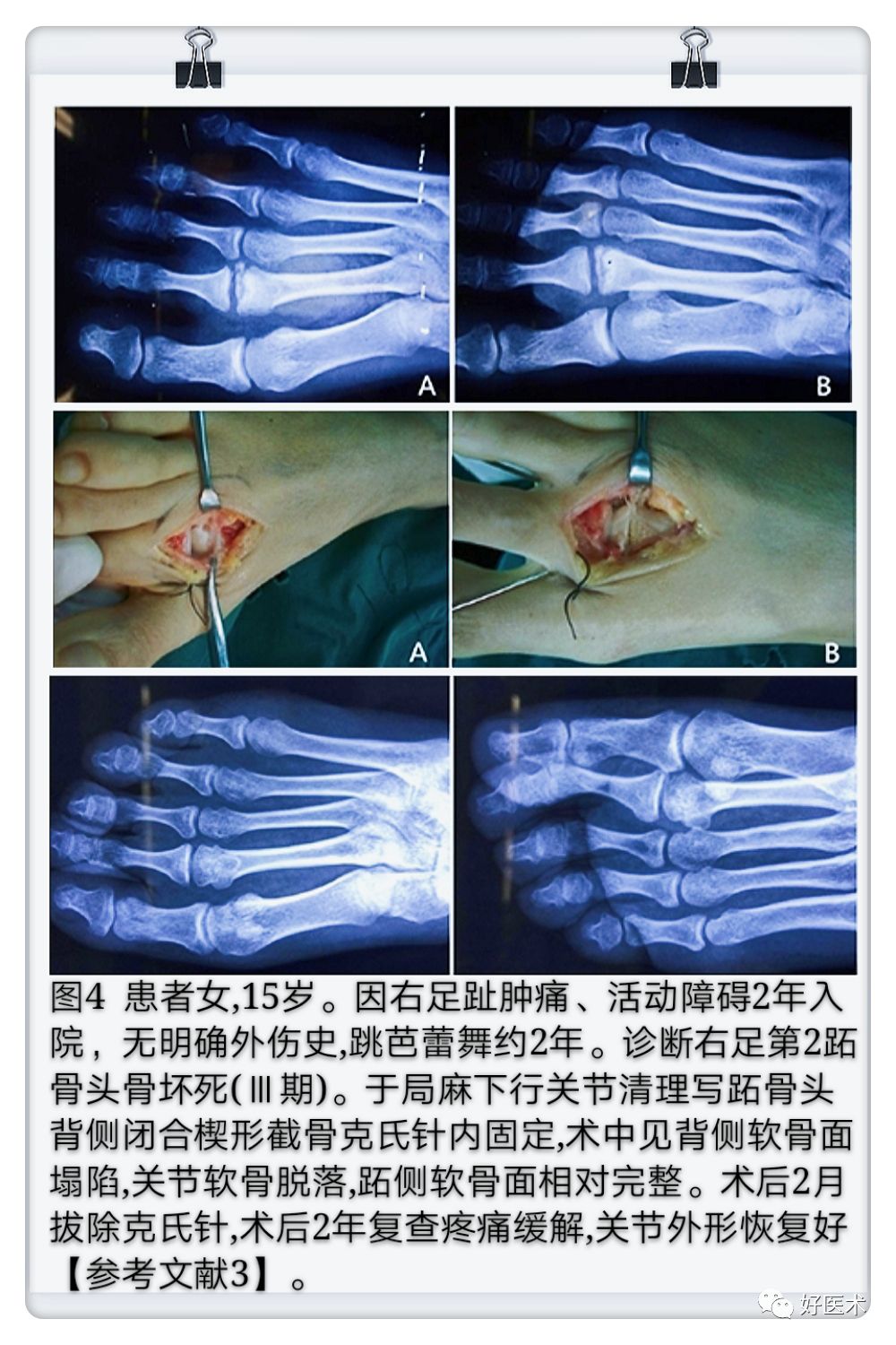 引起前足痛的Freiberg病，你了解吗？