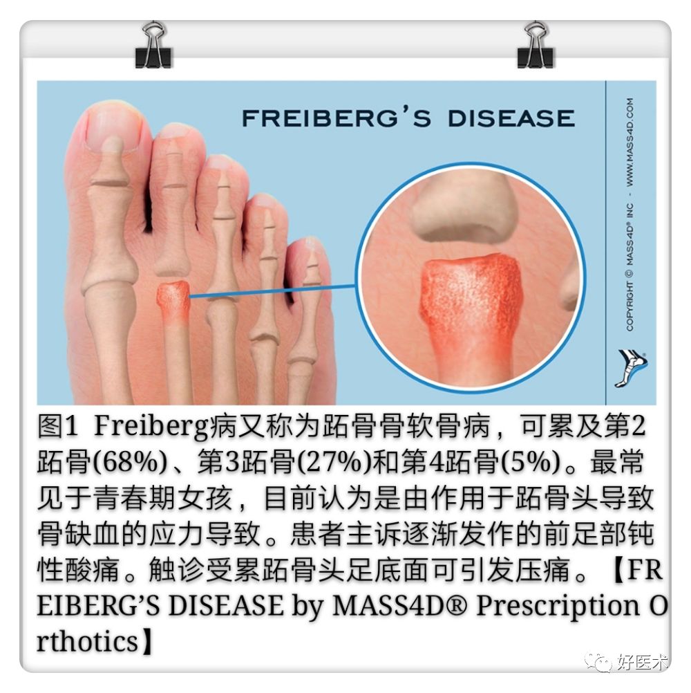 引起前足痛的Freiberg病，你了解吗？