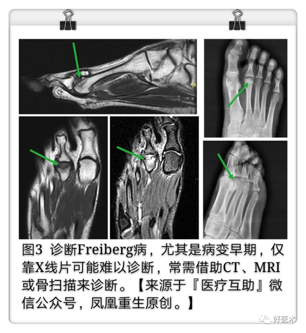 引起前足痛的Freiberg病，你了解吗？