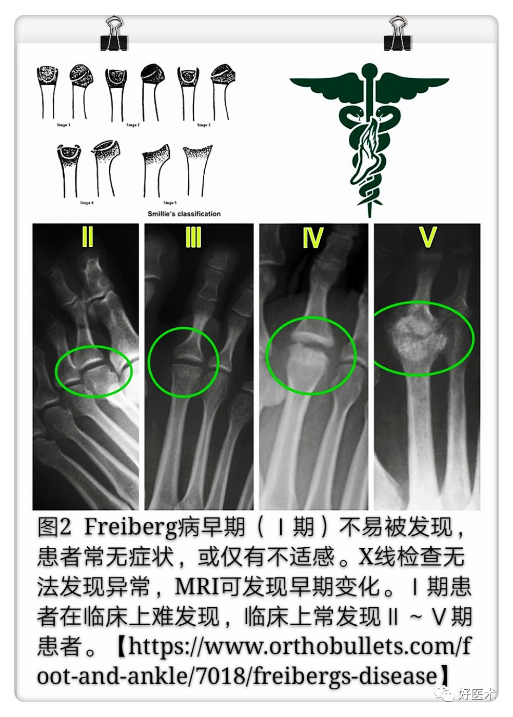 引起前足痛的Freiberg病，你了解吗？