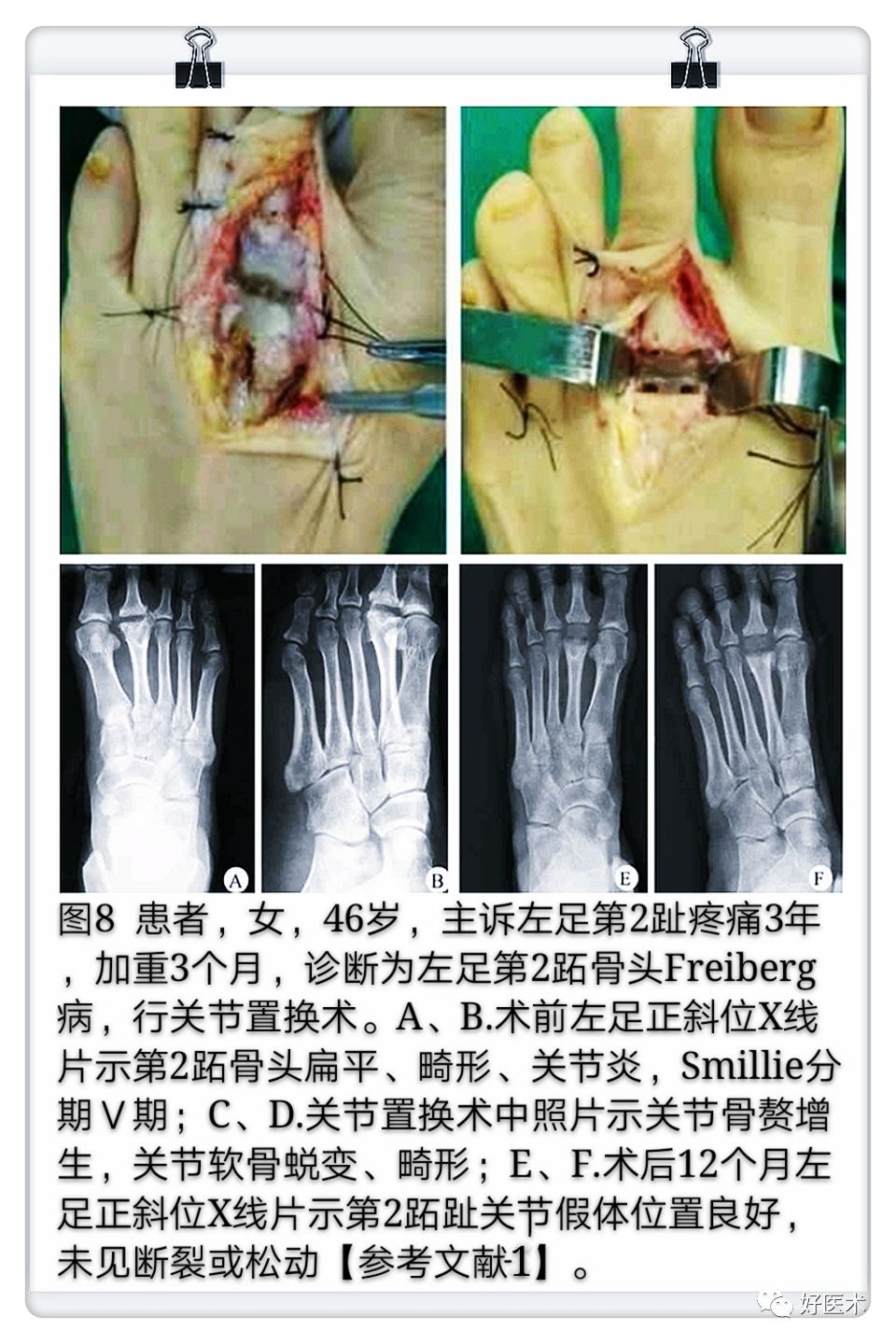 引起前足痛的Freiberg病，你了解吗？