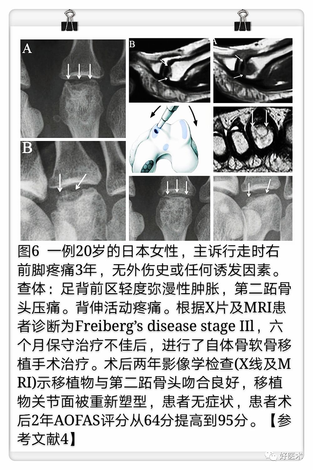 引起前足痛的Freiberg病，你了解吗？