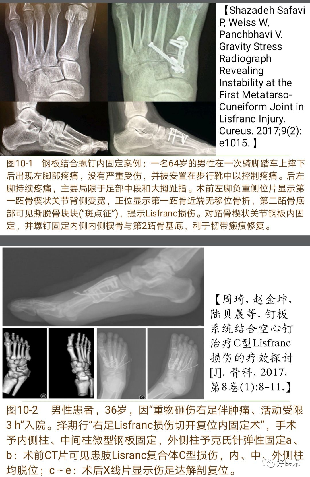 Lisfranc损伤的诊治技巧，看这篇就够了！