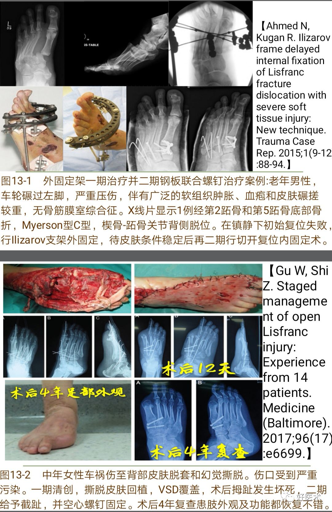 Lisfranc损伤的诊治技巧，看这篇就够了！