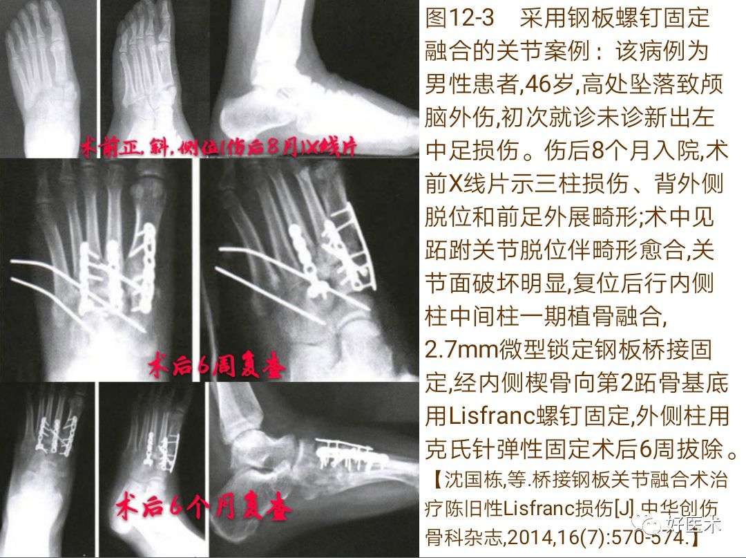 Lisfranc损伤的诊治技巧，看这篇就够了！