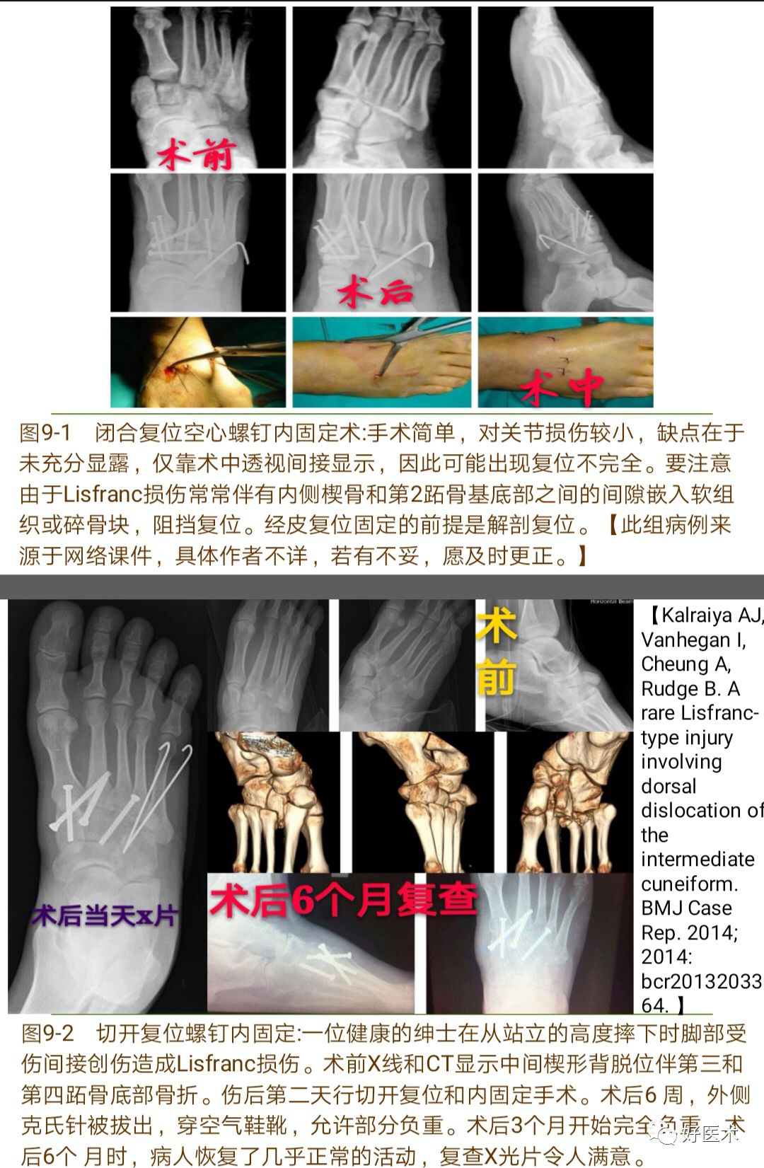 Lisfranc损伤的诊治技巧，看这篇就够了！