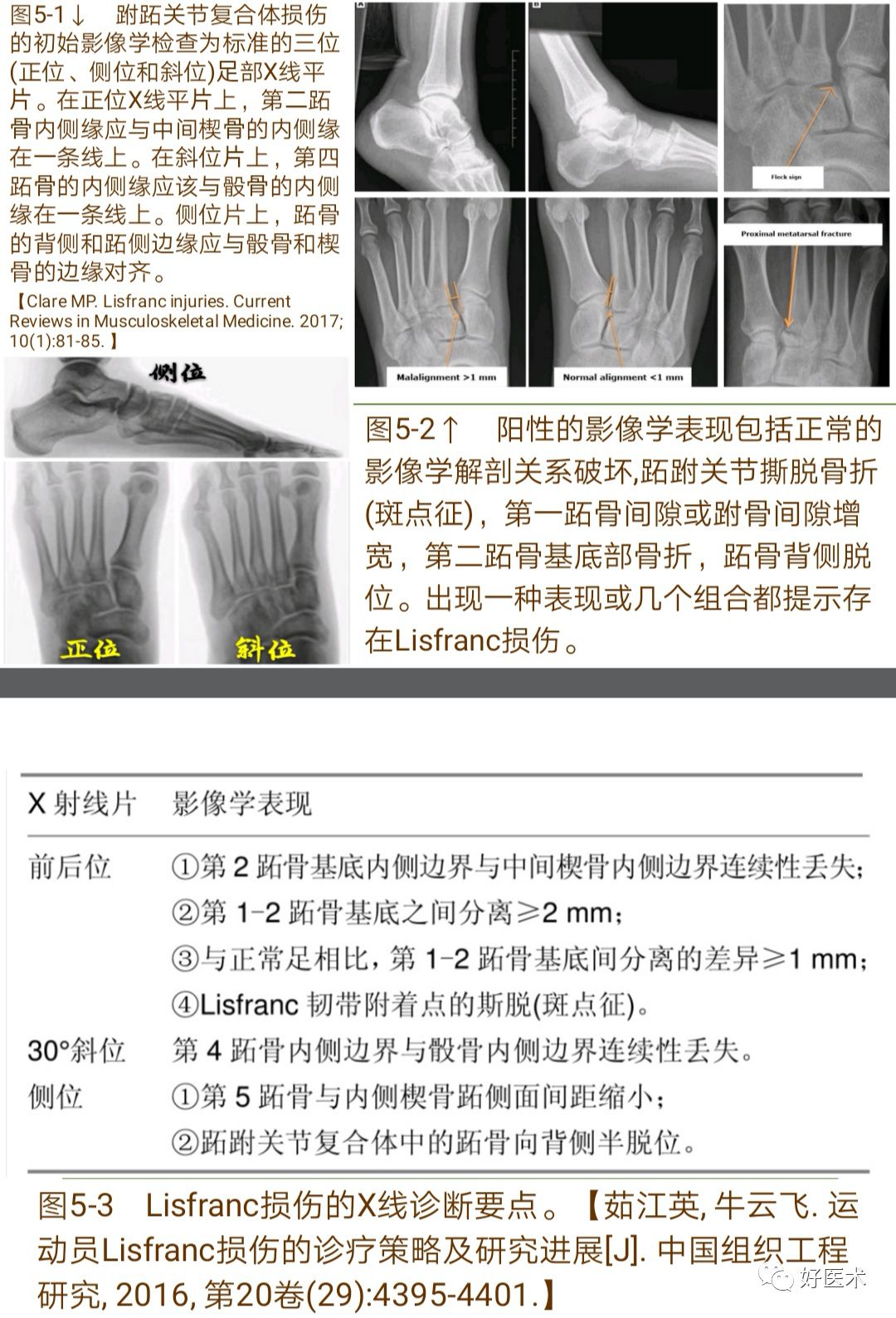 Lisfranc损伤的诊治技巧，看这篇就够了！