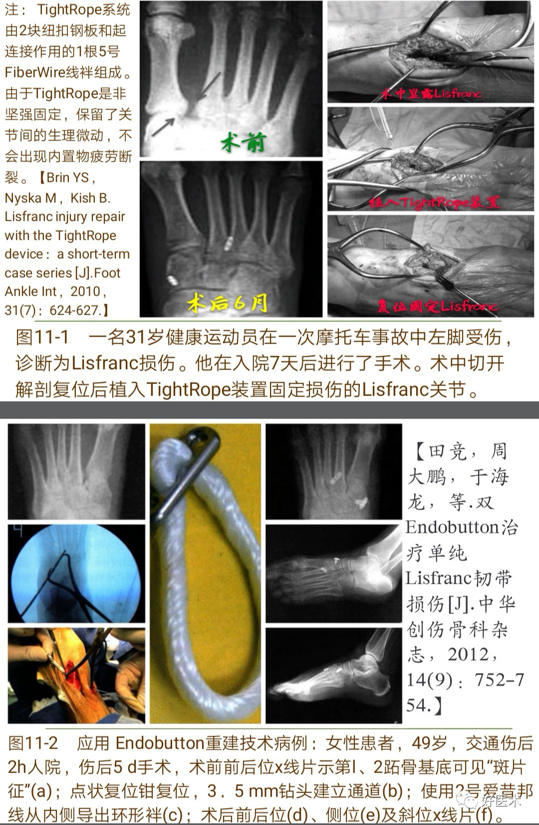 Lisfranc损伤的诊治技巧，看这篇就够了！