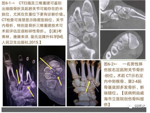 Lisfranc损伤的诊治技巧，看这篇就够了！