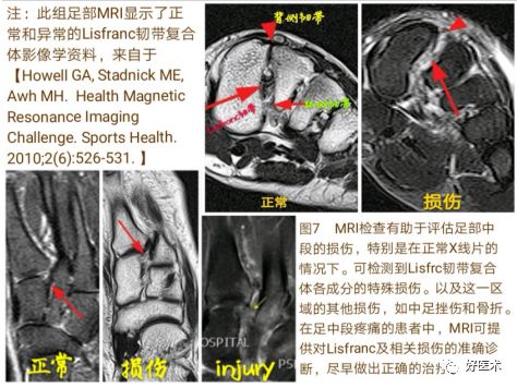 Lisfranc损伤的诊治技巧，看这篇就够了！
