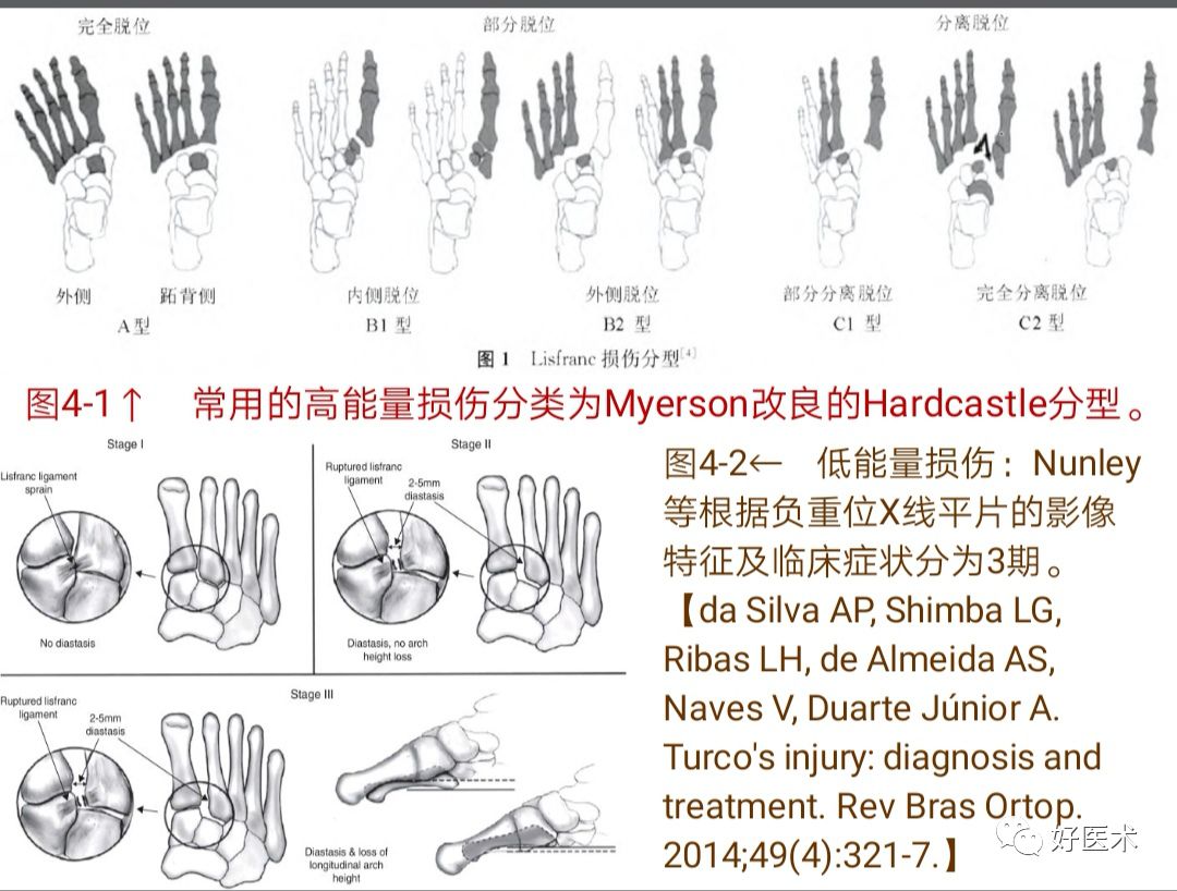 Lisfranc损伤的诊治技巧，看这篇就够了！