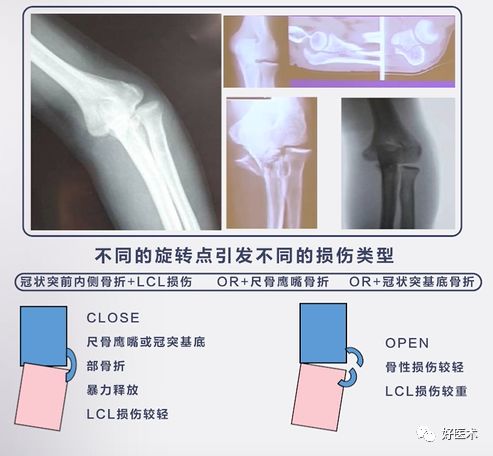 肘关节骨折脱位，我们该如何正确诊治​？