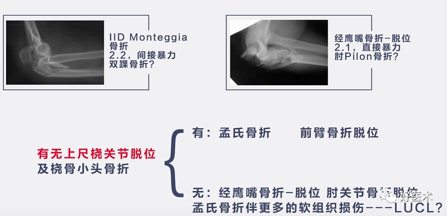 肘关节骨折脱位，我们该如何正确诊治​？