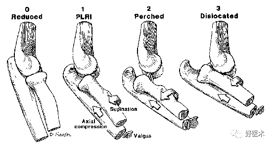 肘关节骨折脱位，我们该如何正确诊治​？