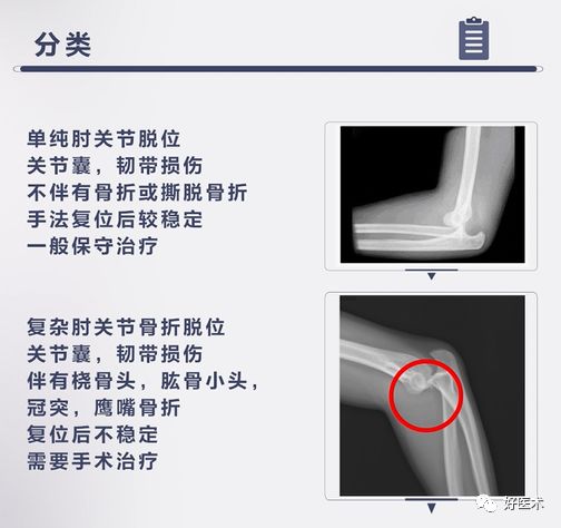 肘关节骨折脱位，我们该如何正确诊治​？