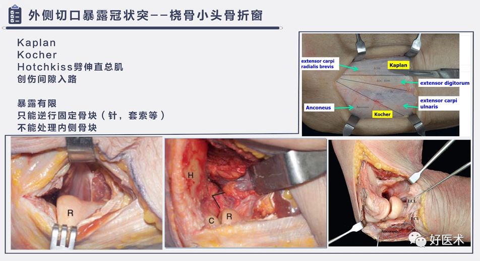 肘关节骨折脱位，我们该如何正确诊治​？